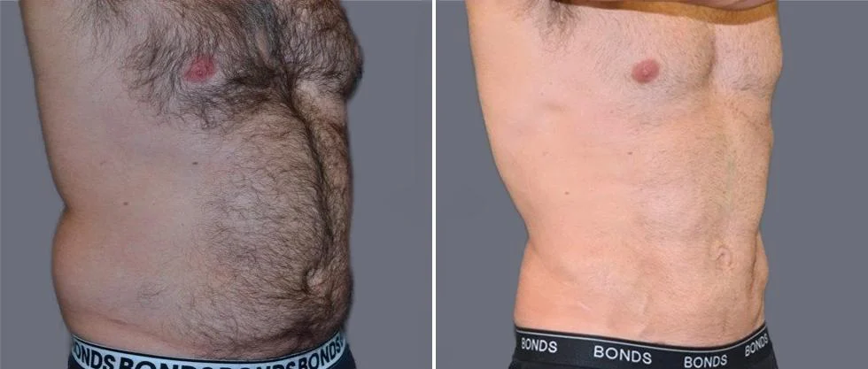 vaser hi definition pre2024 035 before and after before and after