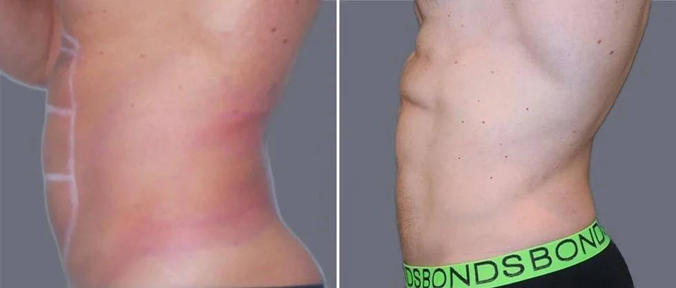 vaser hi definition pre2024 036 before and after before and after