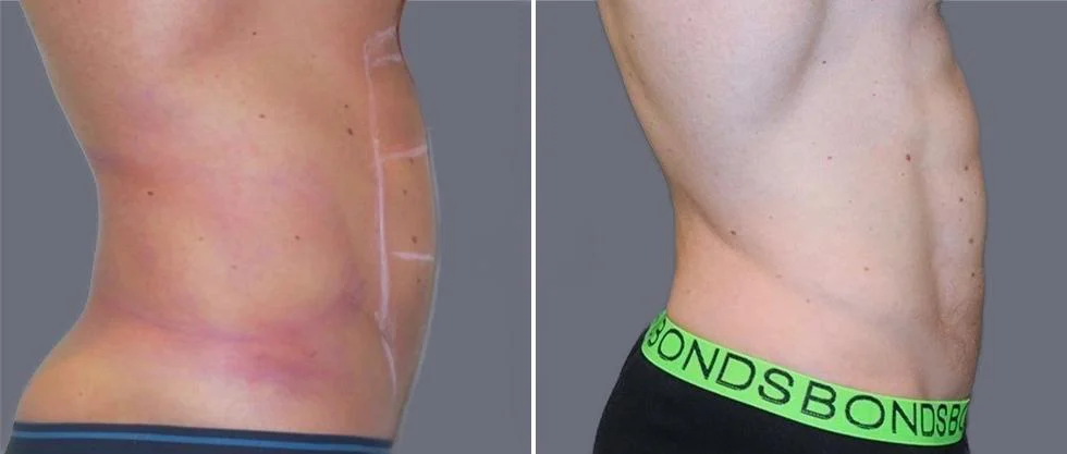 vaser hi definition pre2024 037 before and after before and after