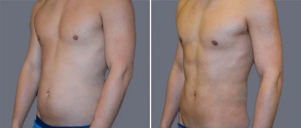 vaser hi definition pre2024 038 before and after before and after