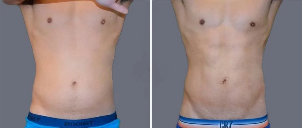 vaser hi definition pre2024 039 before and after before and after