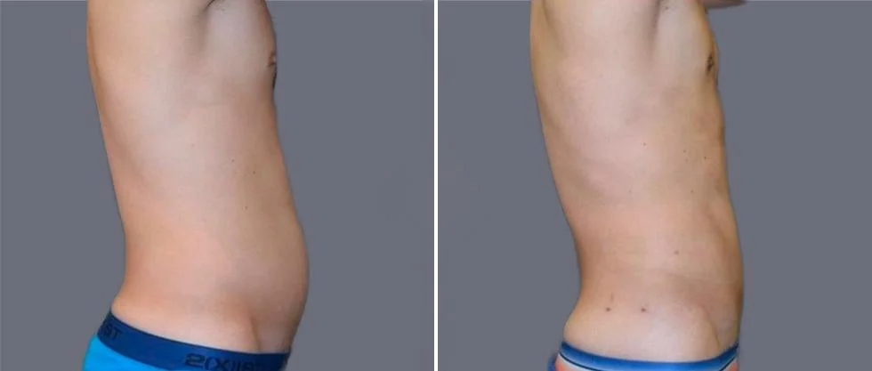 vaser hi definition pre2024 041 before and after before and after