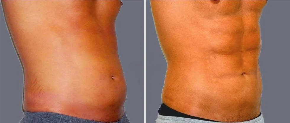 vaser hi definition pre2024 042 before and after before and after