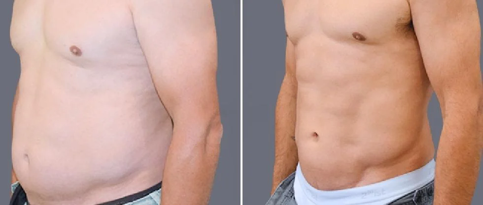 vaser hi definition pre2024 043 before and after before and after