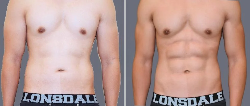 vaser hi definition pre2024 044 before and after before and after