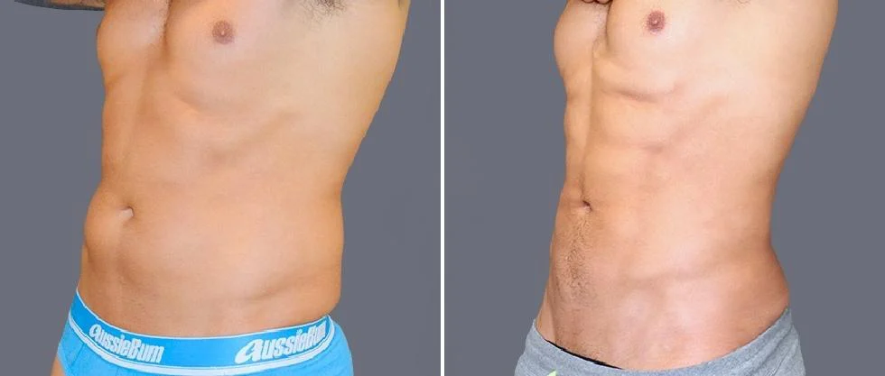 vaser hi definition pre2024 045 before and after before and after
