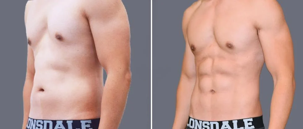 vaser hi definition pre2024 049 before and after before and after