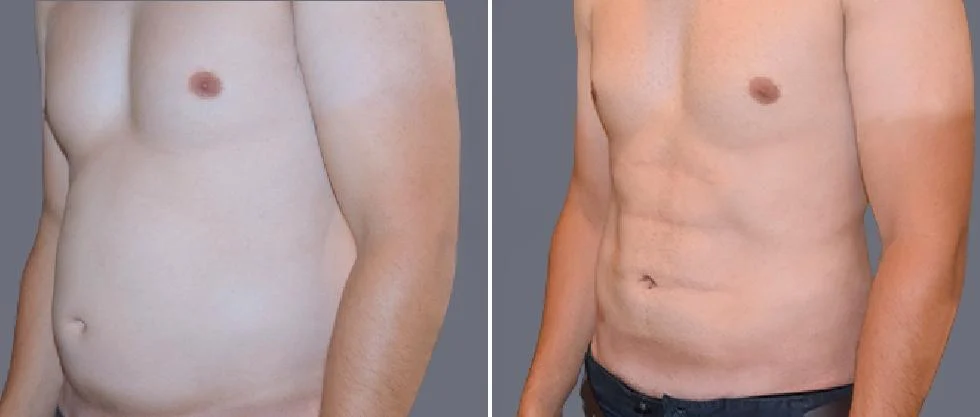 vaser hi definition pre2024 050 before and after before and after