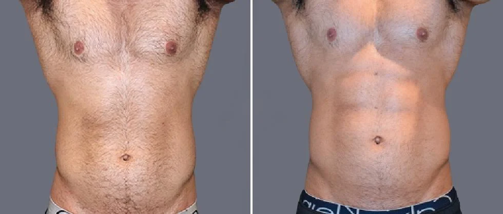 vaser hi definition pre2024 051 before and after before and after
