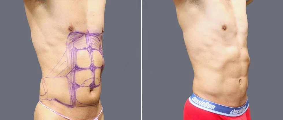 vaser hi definition pre2024 053 before and after before and after
