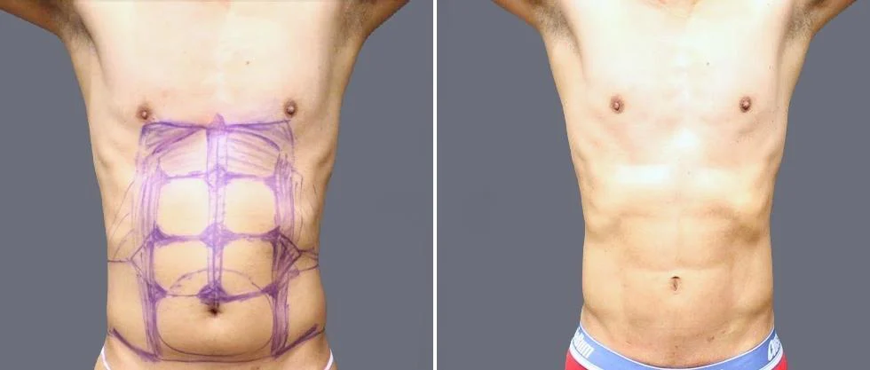 vaser hi definition pre2024 054 before and after before and after