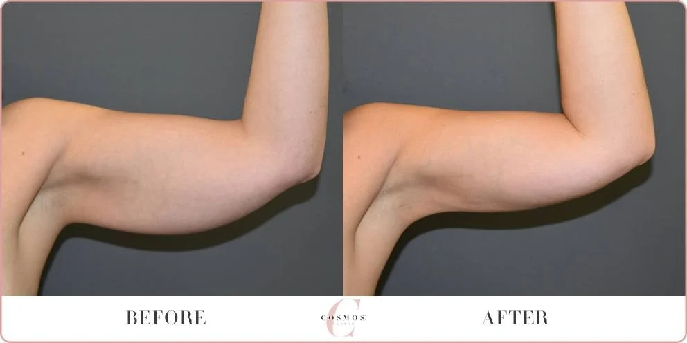 Arm Liposuction before and after at Cosmos Clinic