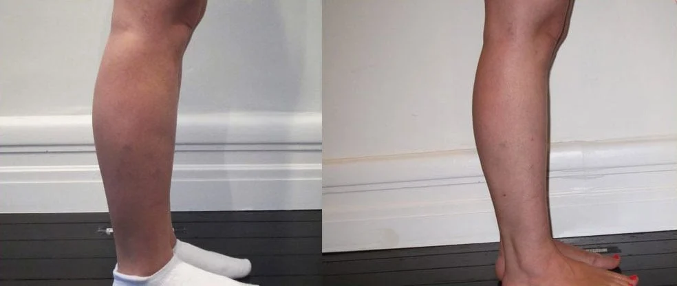 Knees/Calves/Ankles Liposuction before and after at Cosmos Clinic