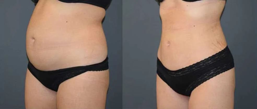 Female Stomach Liposuction before and after at Cosmos Clinic