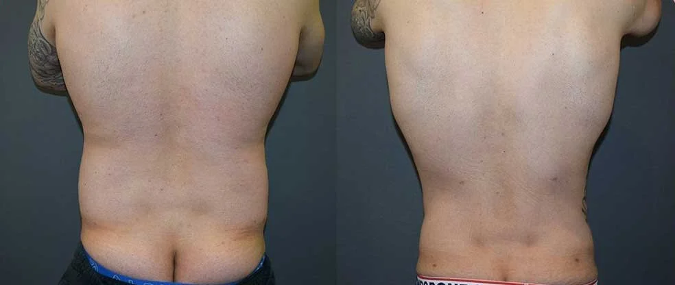 Male Back & Flanks Liposuction before and after at Cosmos Clinic