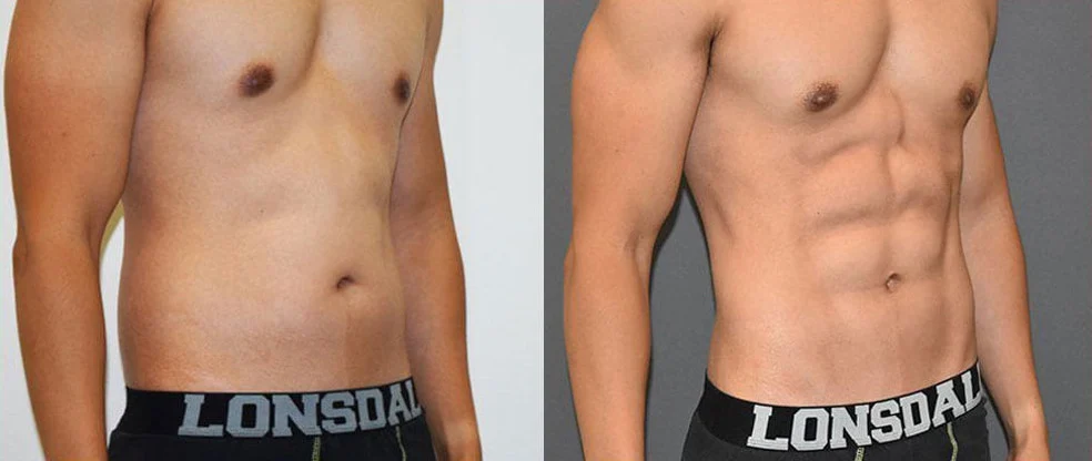 Male Vaser Hi Definition Liposuction before and after at Cosmos Clinic