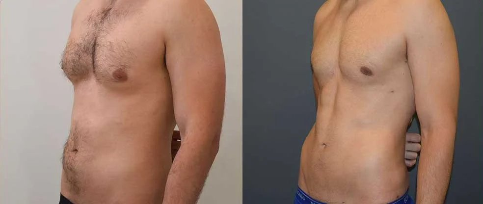 Male Stomach Liposuction before and after at Cosmos Clinic