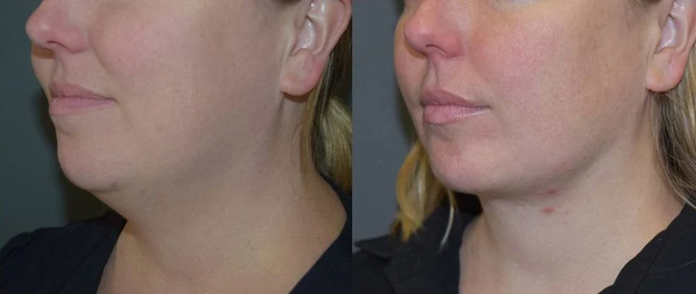 Neck Liposuction before and after at Cosmos Clinic
