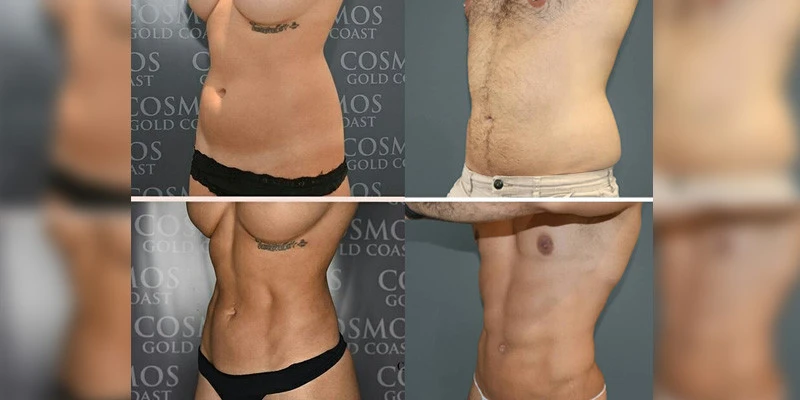 Abdominal Etching Six Packs Examples (and How It Works)