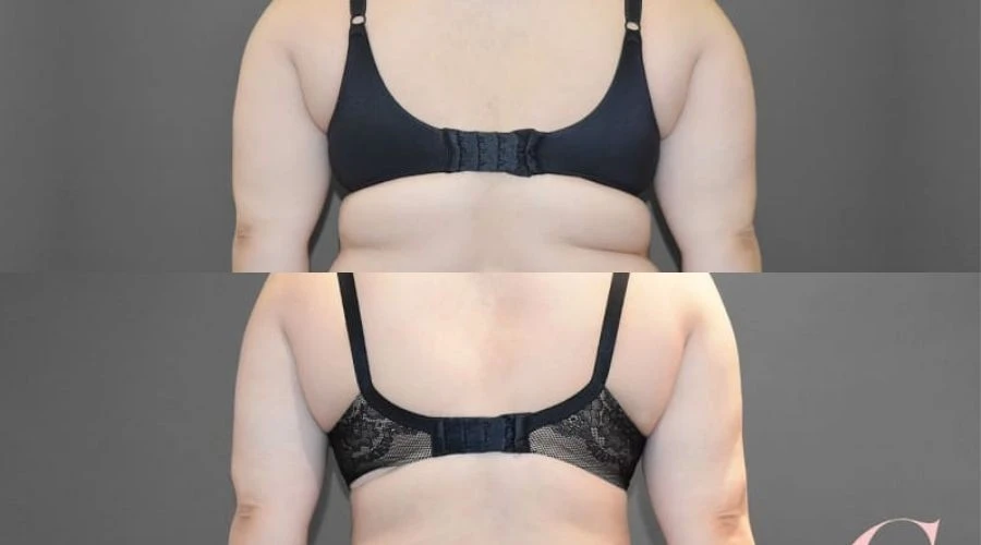 Battling bra fat overhang – the treatment that works