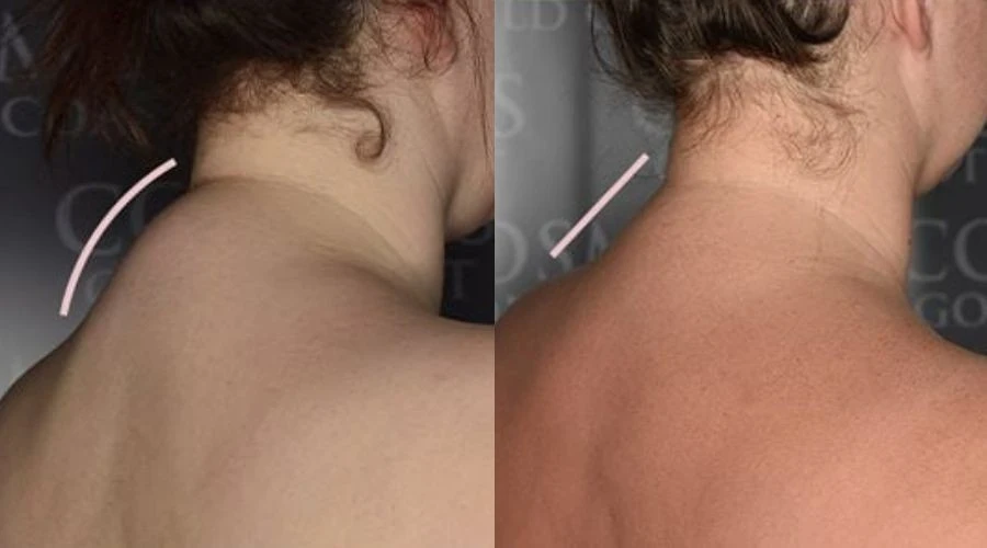 What is buffalo hump and can I remove it?