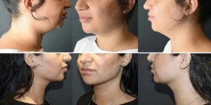 Fixing A Weak Jawline With Cosmetic Surgery
