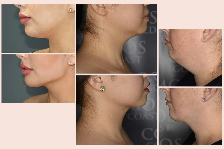 Neck Liposuction Costs And What To Expect